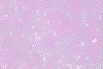 Human in situ pancreatic adenocarcinoma cells-BNCC