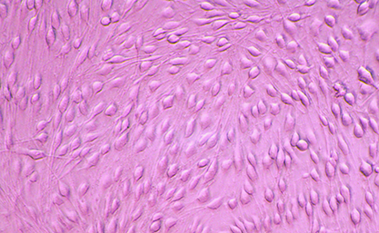 Human lung adenosquamous carcinoma cell-BNCC