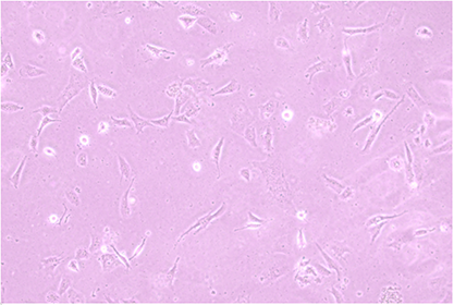 Human poorly differentiated lung adenocarcinoma cells-BNCC